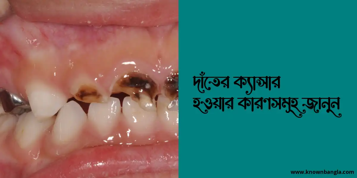 দাঁতের ক্যান্সার হওয়ার কারণসমূহ জানুন