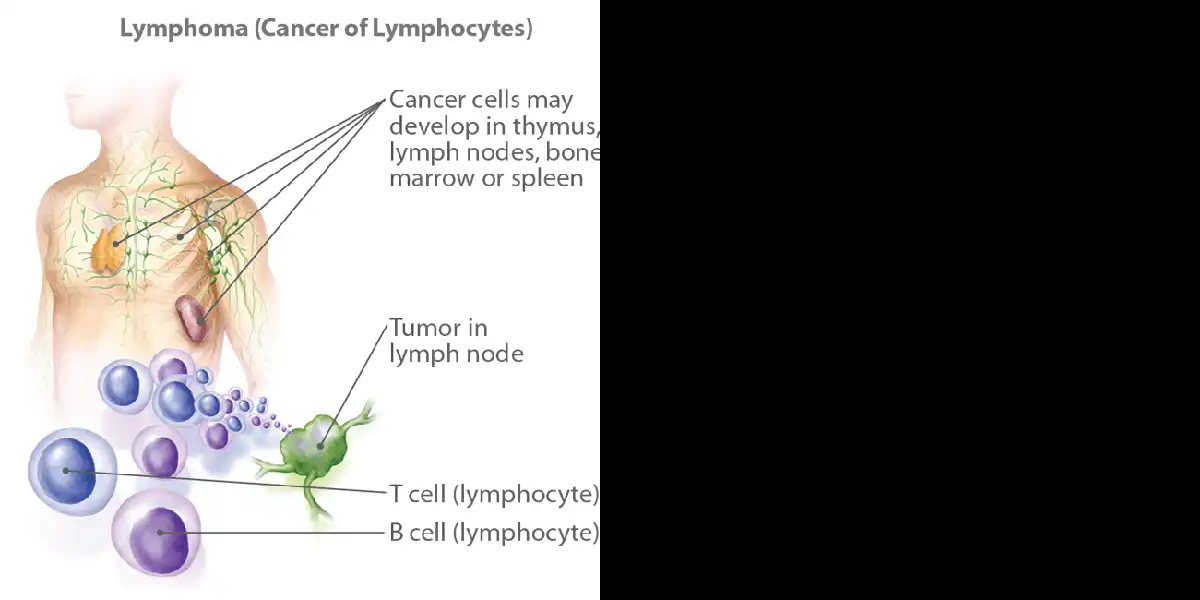লিম্ফোমা: কীভাবে এবং কেন এটি ঘটে, এবং সেরা প্রতিকার