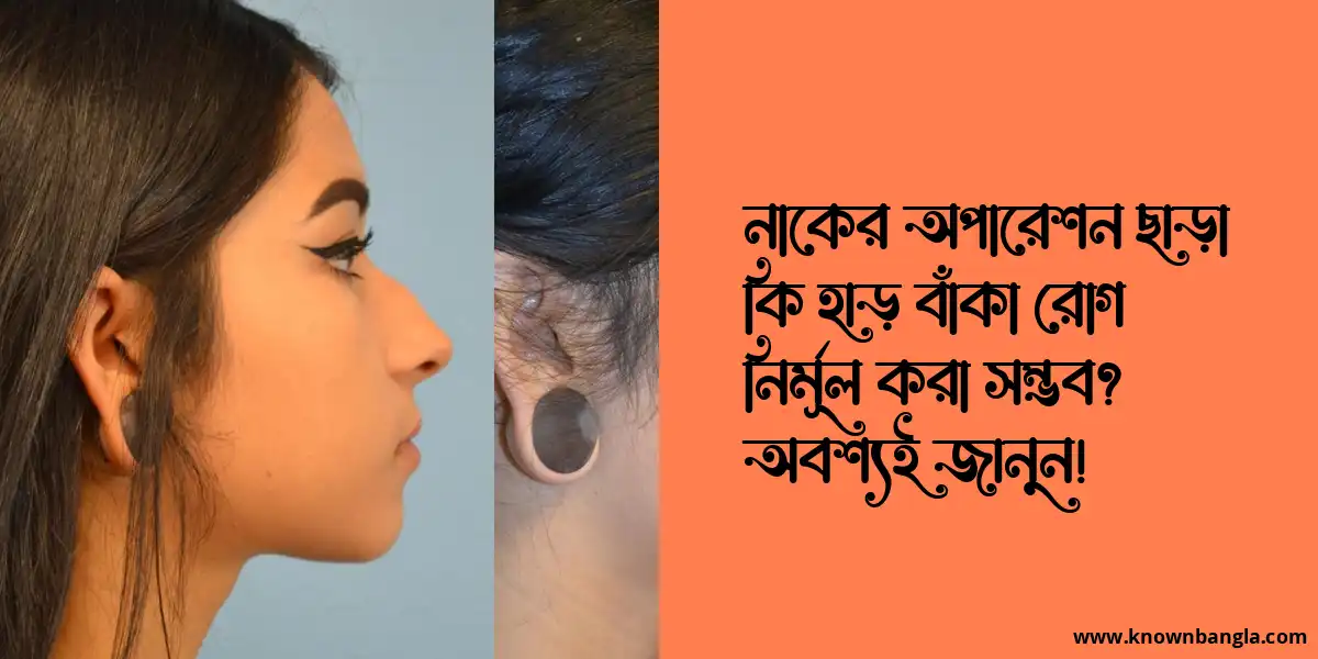 নাকের অপারেশন ছাড়াই হাড় বাঁকা রোগ নির্মূল করা যায়?