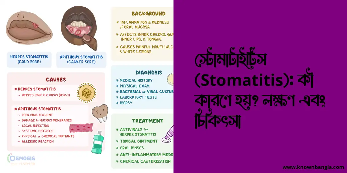 স্টোমাটাইটিস (Stomatitis): কী কারণে হয়? লক্ষণ এবং চিকিৎসা